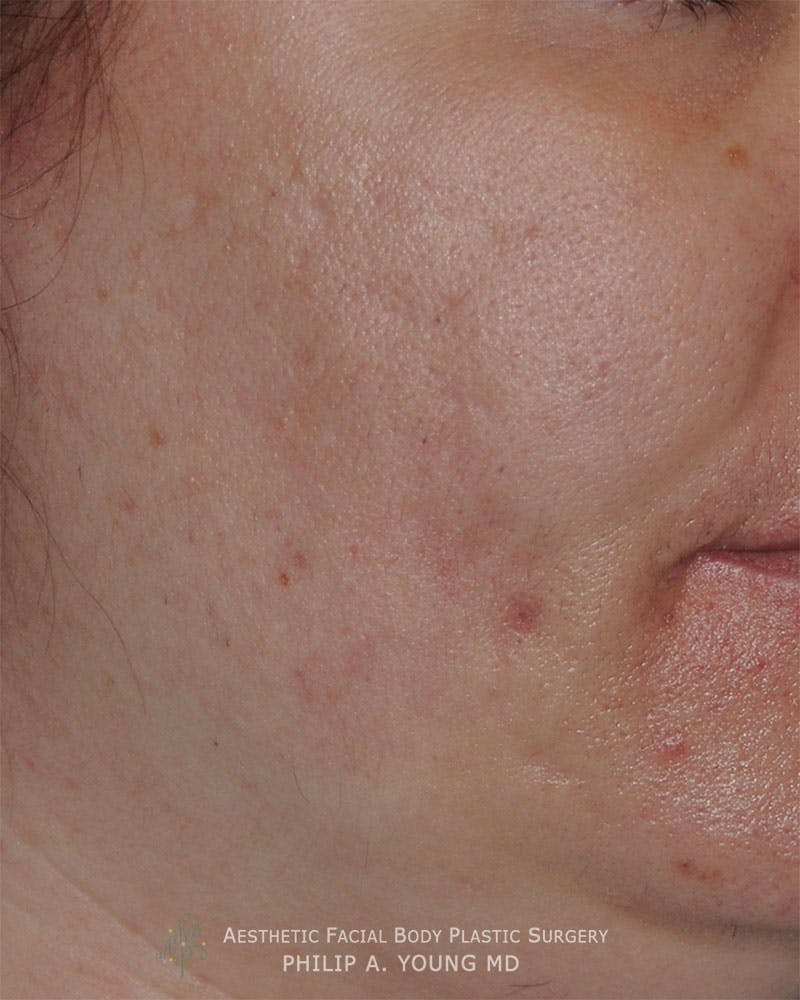 Acne Scar Treatment Before & After Gallery - Patient 414487 - Image 3
