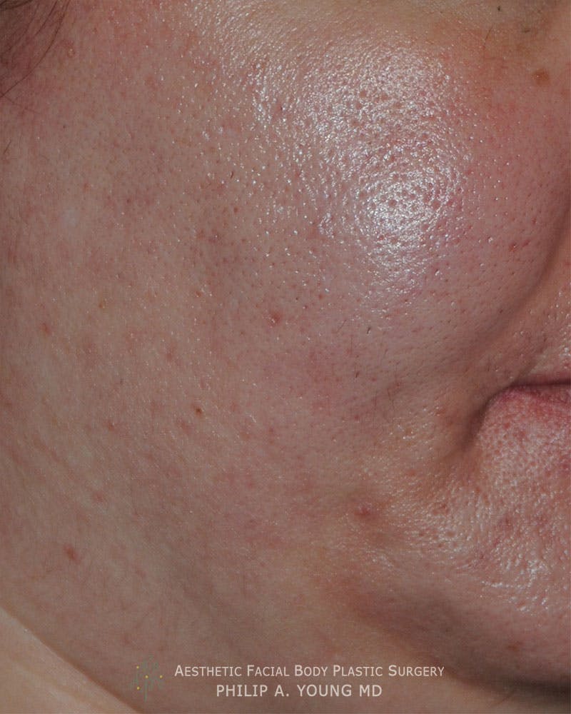 Acne Scar Treatment Before & After Gallery - Patient 414487 - Image 4