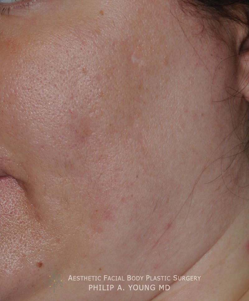 Acne Scar Treatment Before & After Gallery - Patient 414487 - Image 5