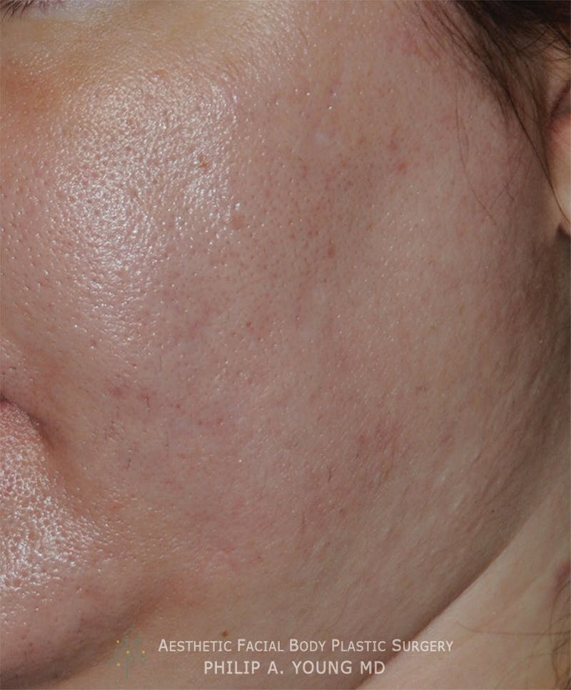 Acne Scar Treatment Before & After Gallery - Patient 414487 - Image 6