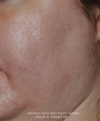 Acne Scar Treatment Before & After Gallery - Patient 414487 - Image 6