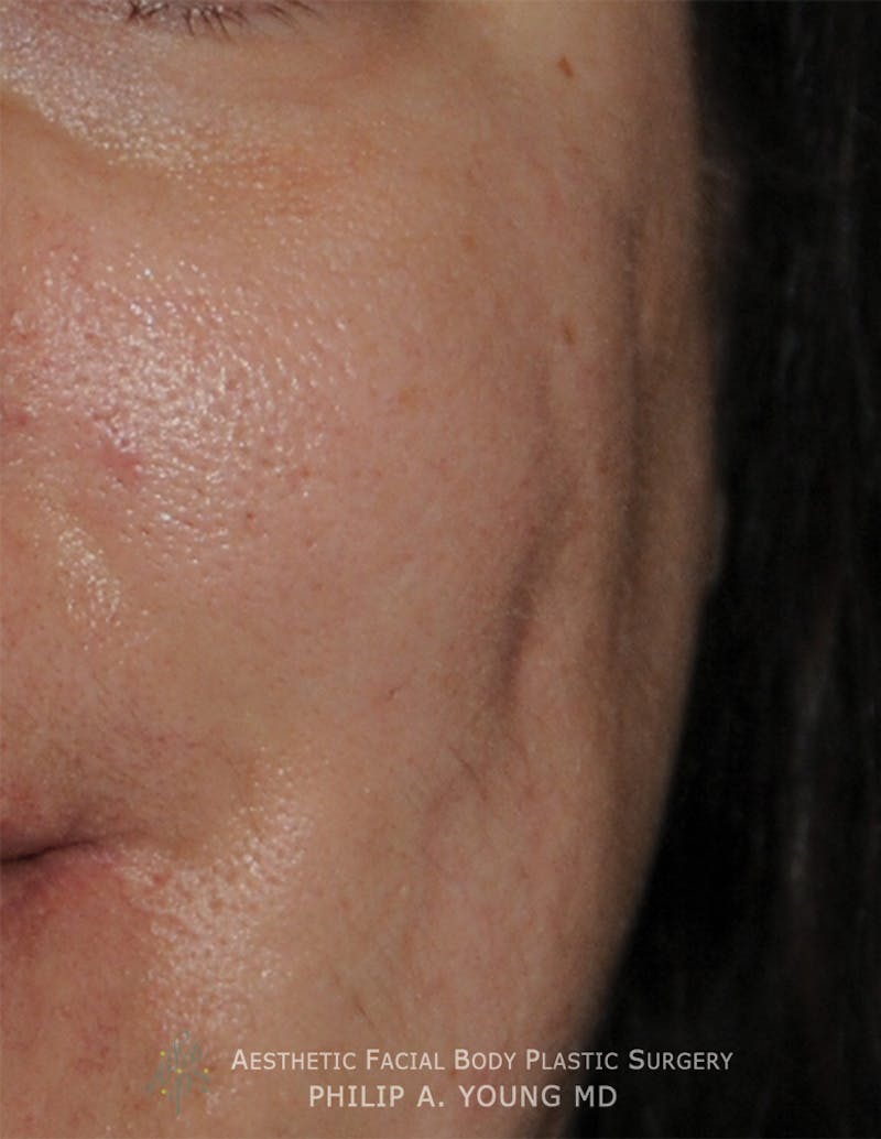 Acne Scar Treatment Before & After Gallery - Patient 414487 - Image 7