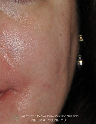 Acne Scar Treatment Before & After Gallery - Patient 414487 - Image 8