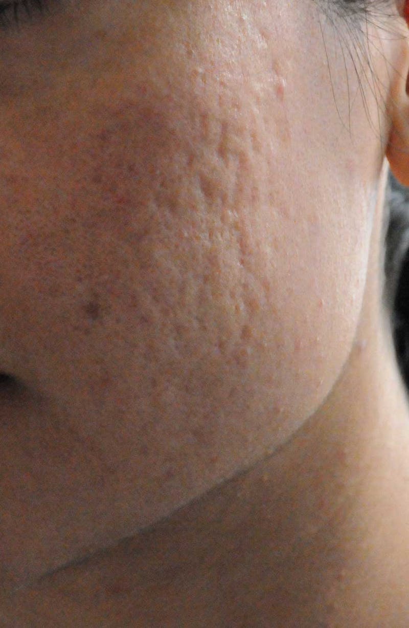 Acne Scar Treatment Before & After Gallery - Patient 119651 - Image 1