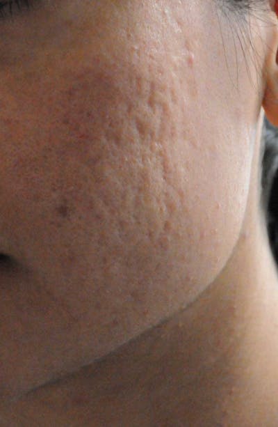 Acne Scar Treatment Before & After Gallery - Patient 119651 - Image 1