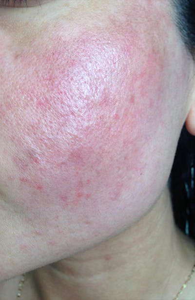Acne Scar Treatment Before & After Gallery - Patient 119651 - Image 2