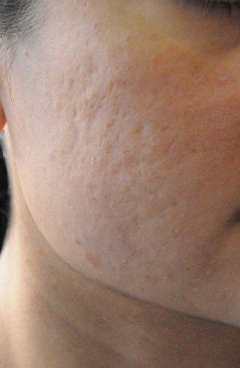 Acne Scar Treatment Before & After Gallery - Patient 119651 - Image 3