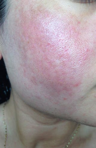Acne Scar Treatment Before & After Gallery - Patient 119651 - Image 4
