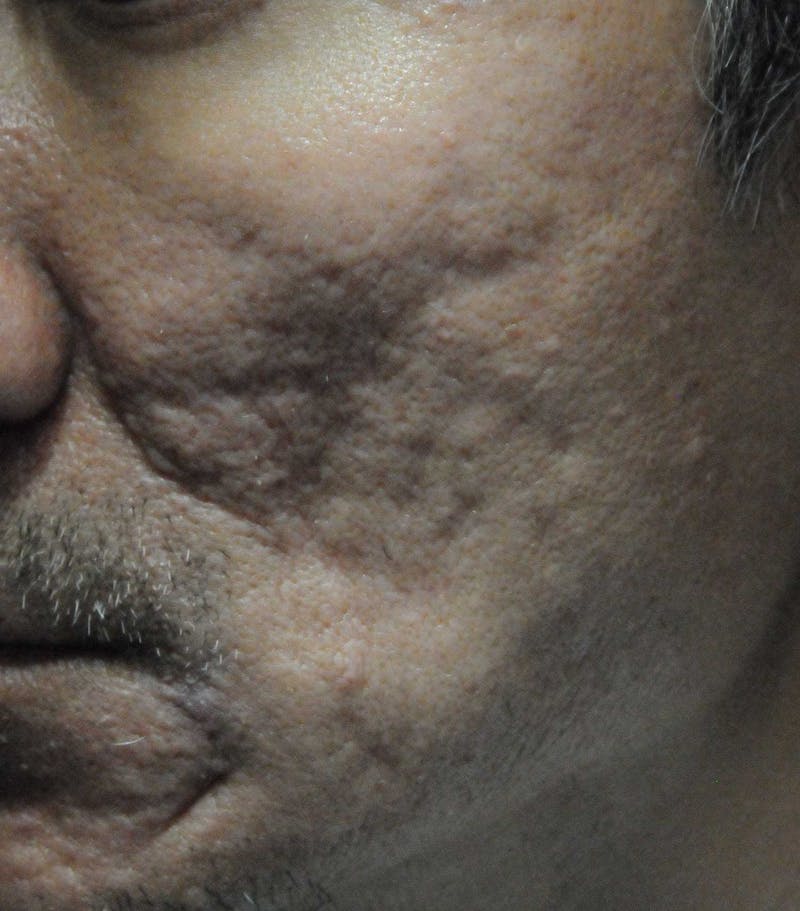 Acne Scar Treatment Before & After Gallery - Patient 247895 - Image 1