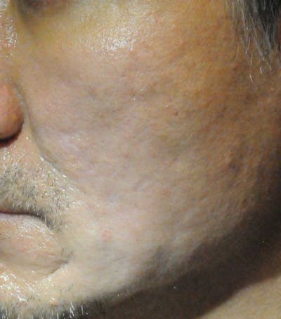 Acne Scar Treatment Before & After Gallery - Patient 247895 - Image 2
