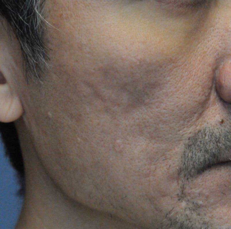 Acne Scar Treatment Before & After Gallery - Patient 247895 - Image 3