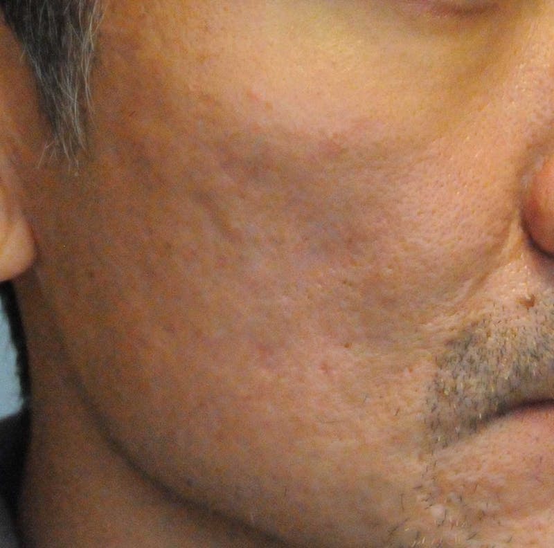 Acne Scar Treatment Before & After Gallery - Patient 247895 - Image 4