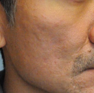 Acne Scar Treatment Before & After Gallery - Patient 247895 - Image 4