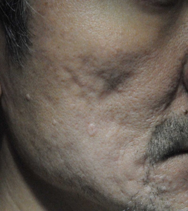 Acne Scar Treatment Before & After Gallery - Patient 247895 - Image 5