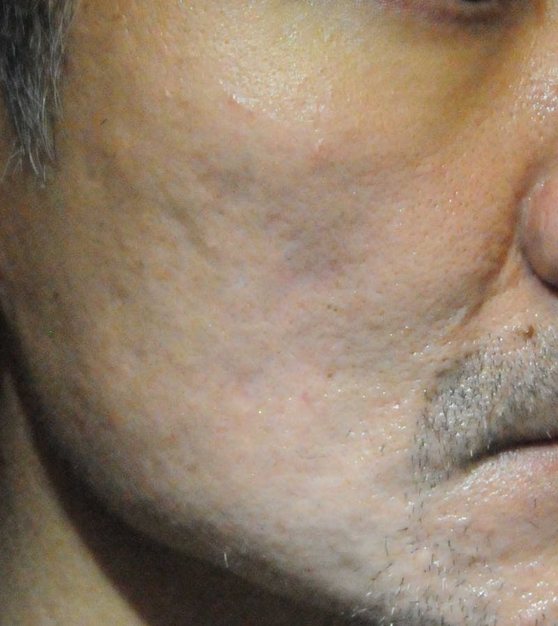 Acne Scar Treatment Before & After Gallery - Patient 247895 - Image 6