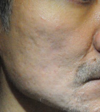 Acne Scar Treatment Before & After Gallery - Patient 247895 - Image 6
