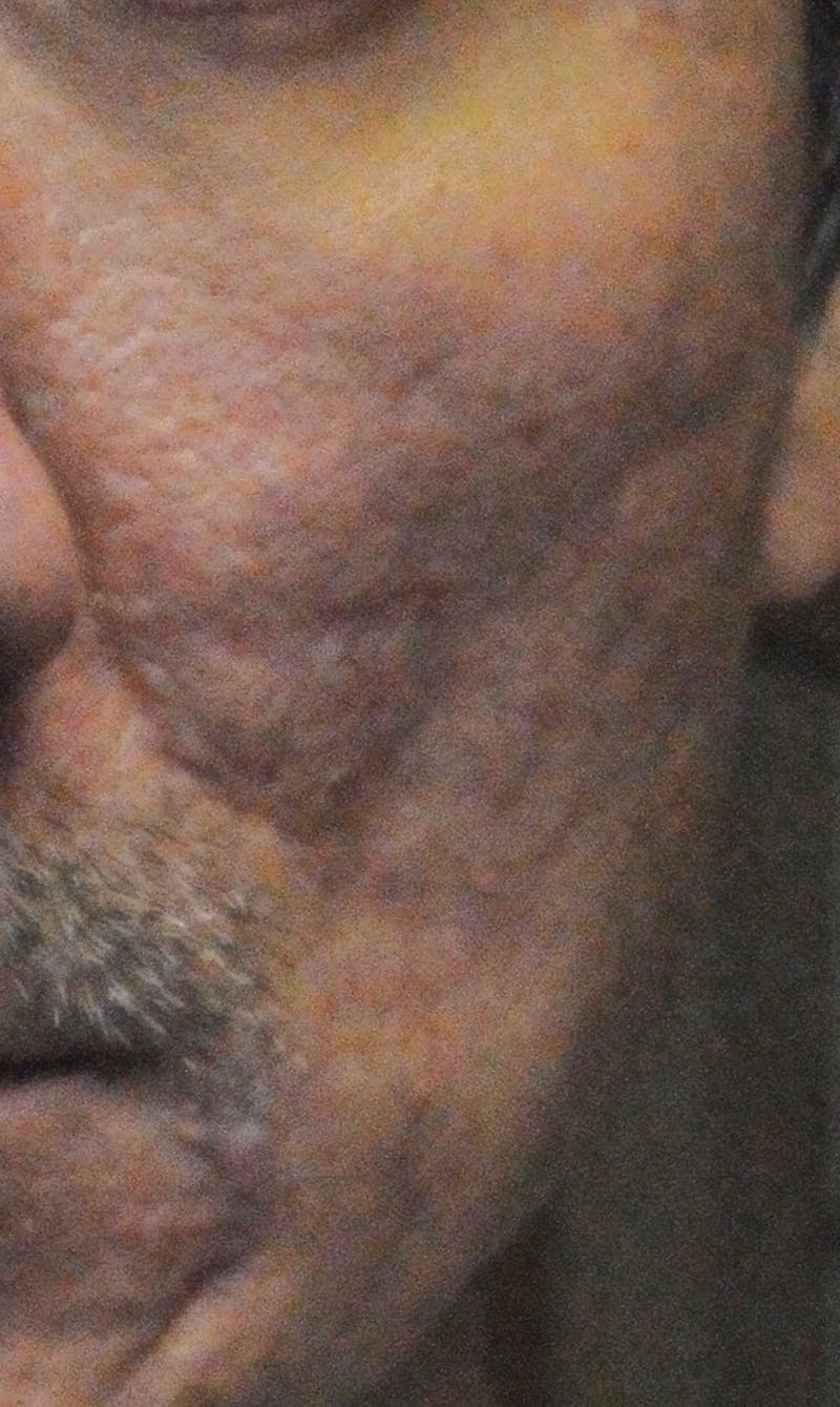 Acne Scar Treatment Before & After Gallery - Patient 247895 - Image 7