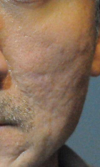 Acne Scar Treatment Before & After Gallery - Patient 247895 - Image 8