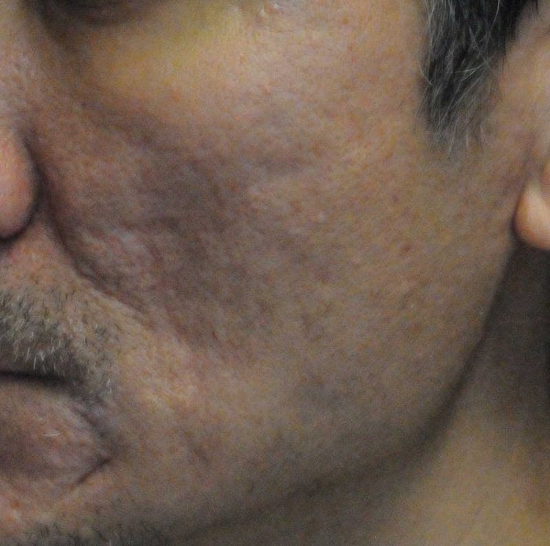 Acne Scar Treatment Before & After Gallery - Patient 247895 - Image 9