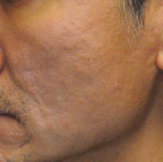 Acne Scar Treatment Before & After Gallery - Patient 247895 - Image 10