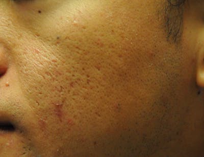 Acne Scar Treatment Before & After Gallery - Patient 289680 - Image 1