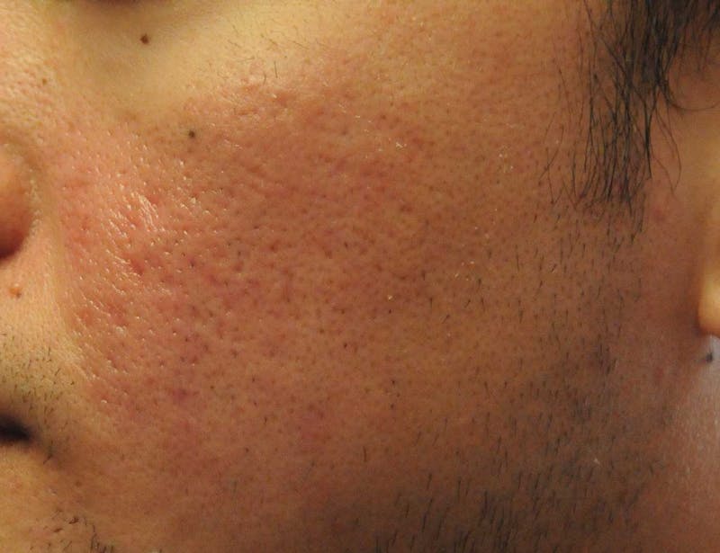 Scar Revision Before & After Gallery - Patient 318314 - Image 2