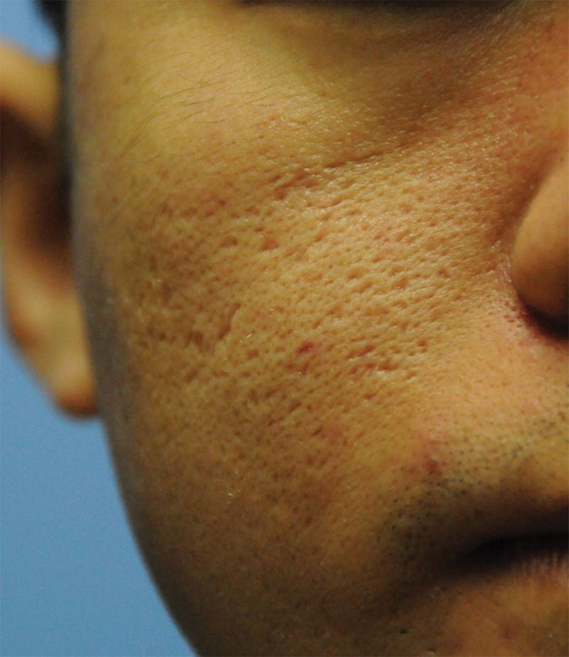 Acne Scar Treatment Before & After Gallery - Patient 362493 - Image 1