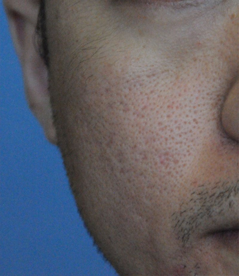 Acne Scar Treatment Before & After Gallery - Patient 362493 - Image 2