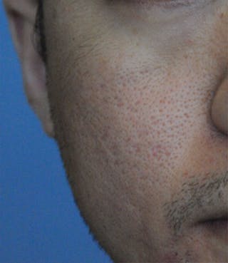Acne Scar Treatment Before & After Gallery - Patient 362493 - Image 2