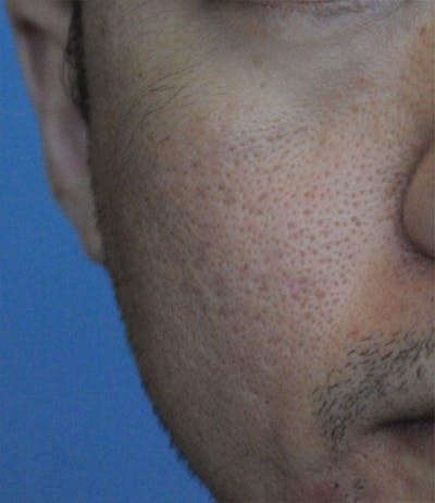 Acne Scar Treatment Before & After Gallery - Patient 362493 - Image 2