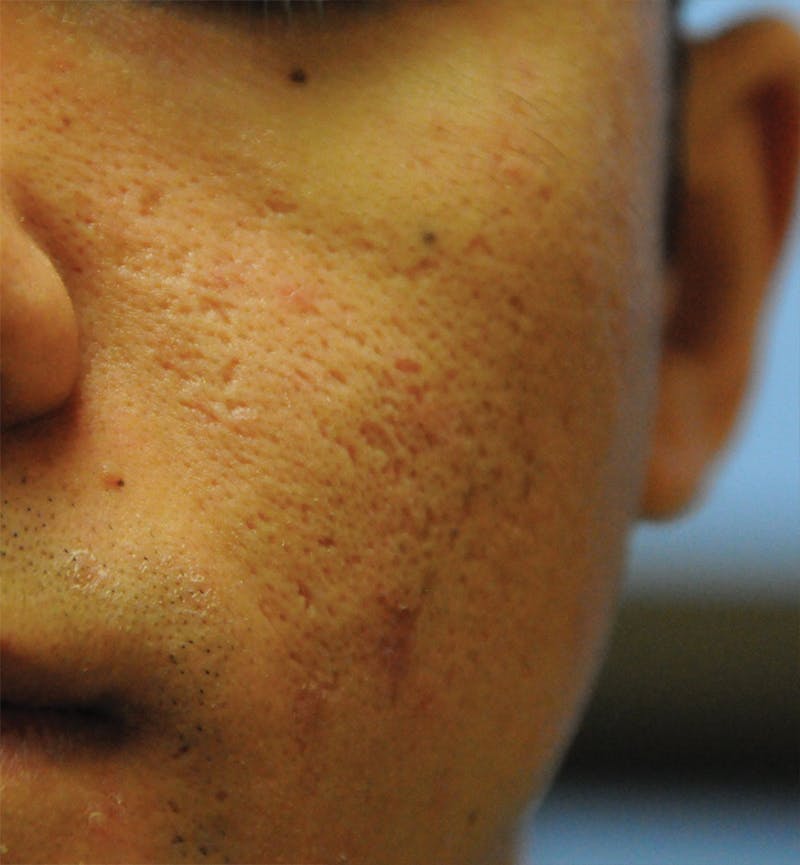 Acne Scar Treatment Before & After Gallery - Patient 362493 - Image 3