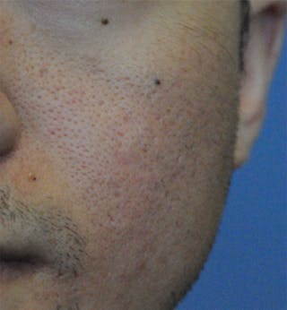 Acne Scar Treatment Before & After Gallery - Patient 362493 - Image 4