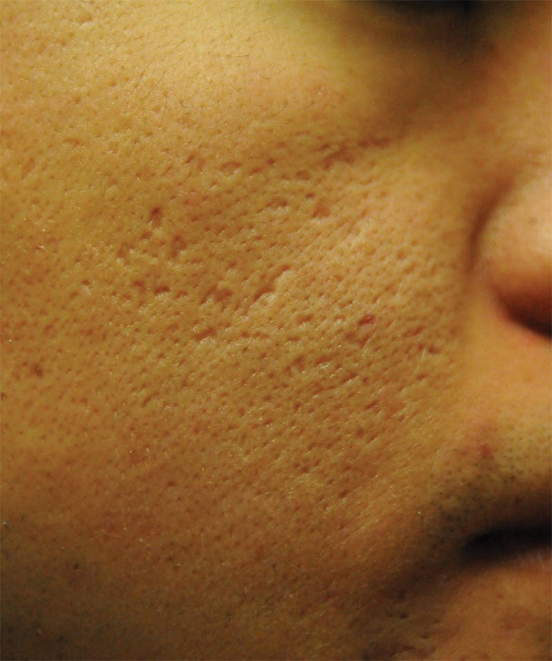 Acne Scar Treatment Before & After Gallery - Patient 362493 - Image 5
