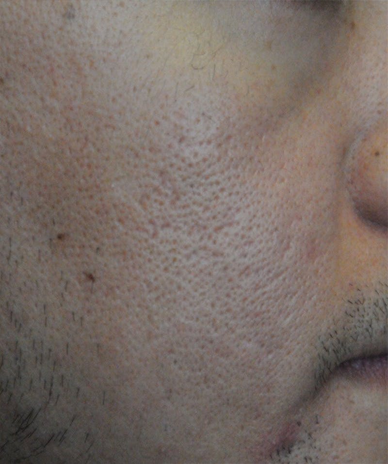 Acne Scar Treatment Before & After Gallery - Patient 362493 - Image 6