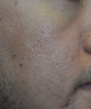 Acne Scar Treatment Before & After Gallery - Patient 362493 - Image 6