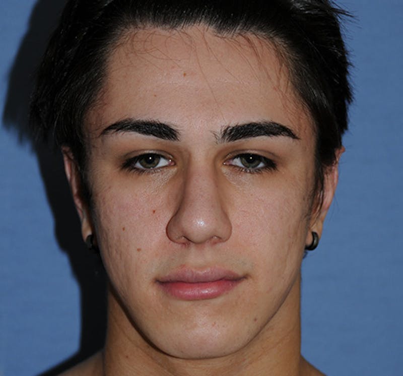 Laser Resurfacing Before & After Gallery - Patient 426189 - Image 1