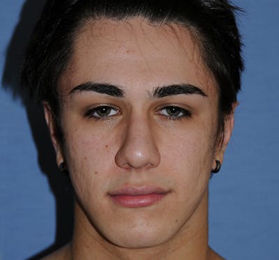 Acne Scar Treatment Before & After Gallery - Patient 415344 - Image 1
