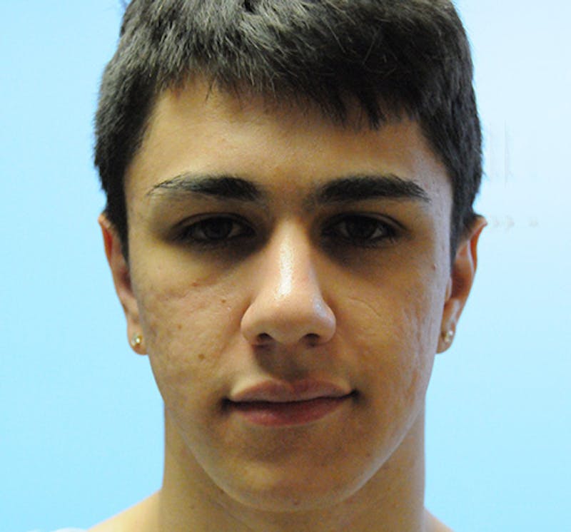 Scar Revision Before & After Gallery - Patient 297225 - Image 1