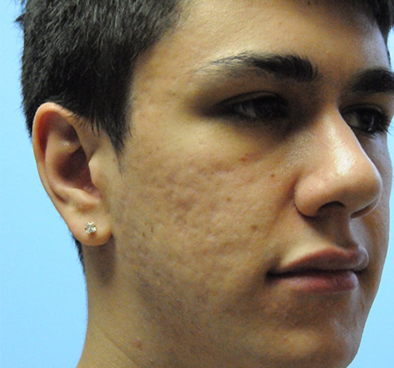 Scar Revision Before & After Gallery - Patient 297225 - Image 3