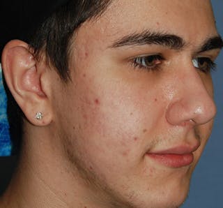 Scar Revision Before & After Gallery - Patient 297225 - Image 4