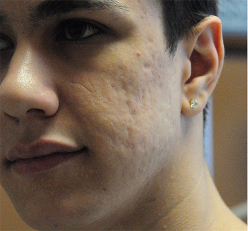 Scar Revision Before & After Gallery - Patient 297225 - Image 5