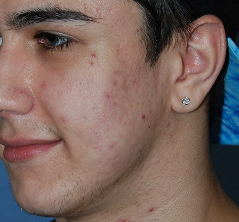 Scar Revision Before & After Gallery - Patient 297225 - Image 6