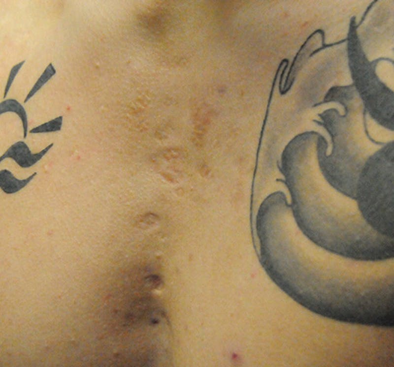Scar Revision Before & After Gallery - Patient 297225 - Image 7