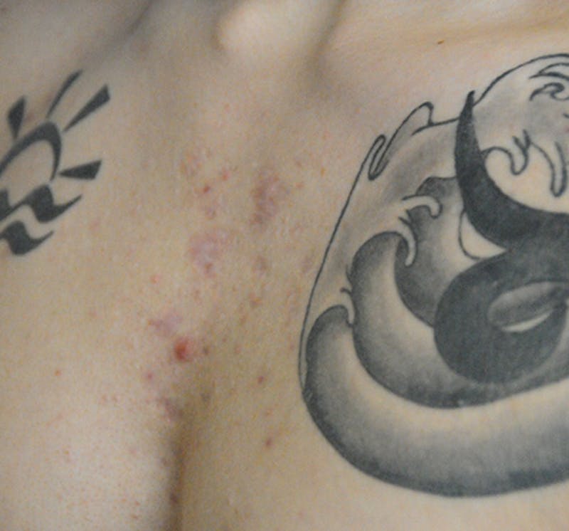 Scar Revision Before & After Gallery - Patient 297225 - Image 8