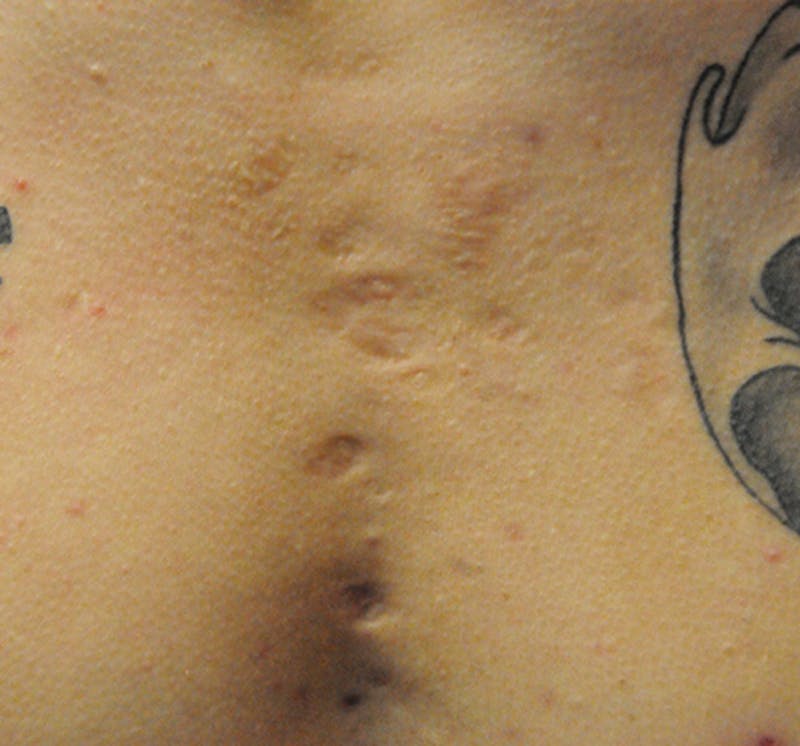 Scar Revision Before & After Gallery - Patient 297225 - Image 9