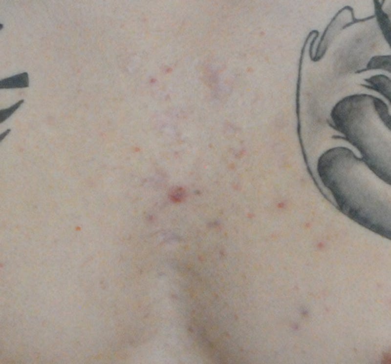 Scar Revision Before & After Gallery - Patient 297225 - Image 10