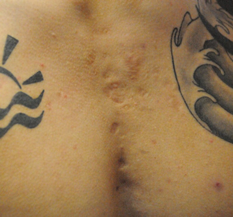 Scar Revision Before & After Gallery - Patient 297225 - Image 11