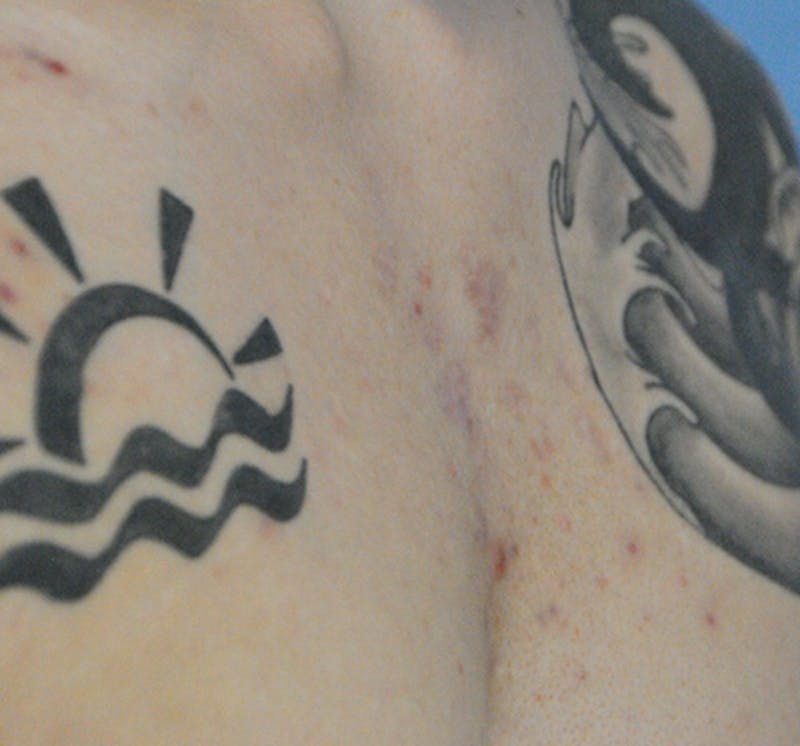 Scar Revision Before & After Gallery - Patient 297225 - Image 12
