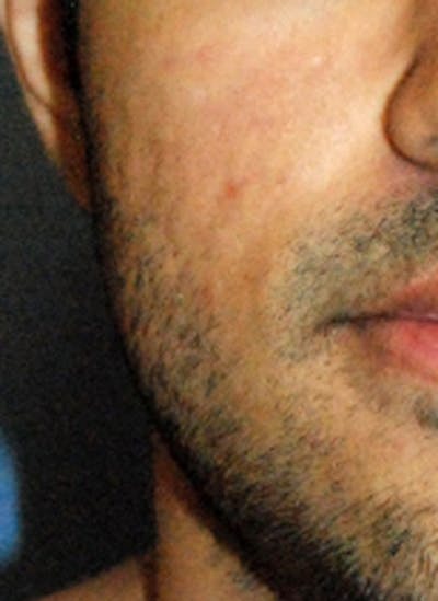 Acne Scar Treatment Before & After Gallery - Patient 300423 - Image 1