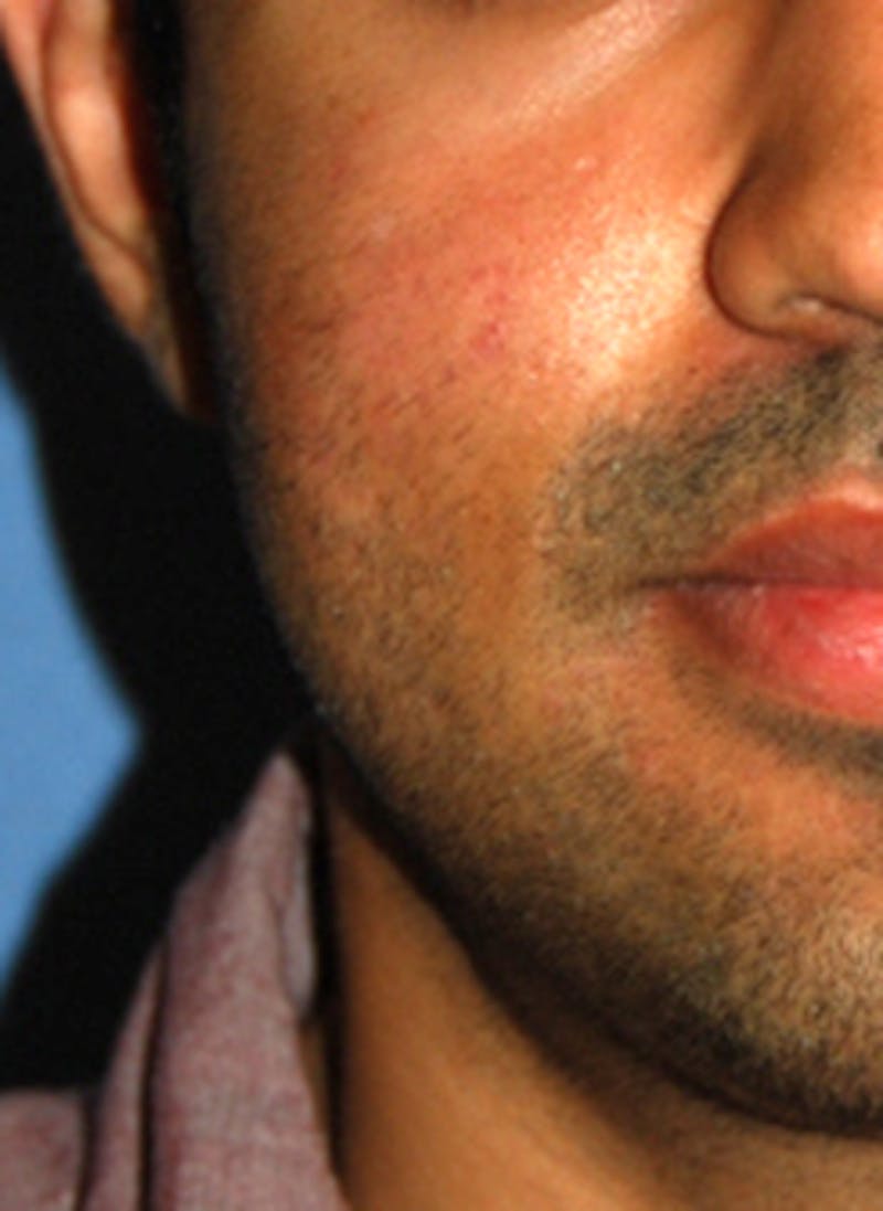 Scar Revision Before & After Gallery - Patient 197778 - Image 4